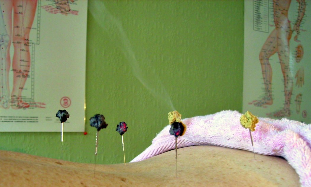 Moxibustion2